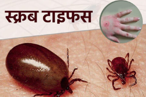 दुई हजारको जाँच गर्दा ३८६ जनामा स्क्रब टाइफस , एकजनाको मृत्यु