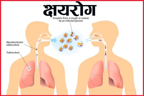 आज विश्व क्षयरोग दिवस